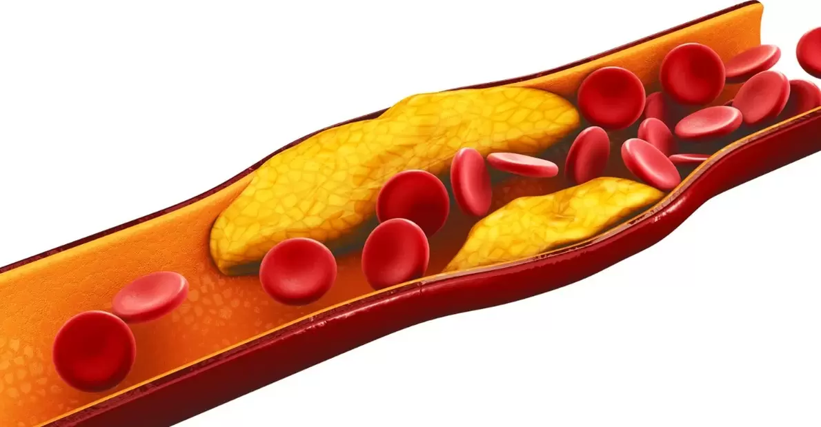 Der Grund für die Einnahme von MiCardium-Kapseln ist vaskuläre Arteriosklerose